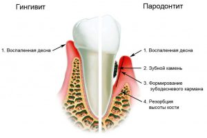 parodontit-i-gingivit Пародонтит и гингивит
